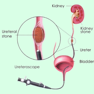 Endourology Treatment In Indore