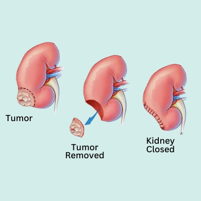 Uro Oncology Treatment in Indore